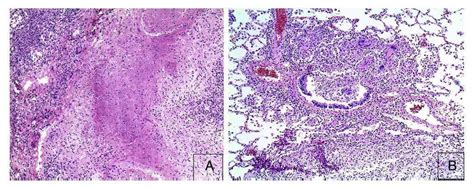 Miliary Tuberculosis Histology