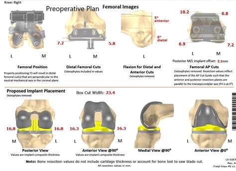 Case Study: Bilateral Knee Replacement in 72 Year Old Female