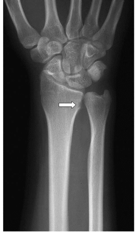 A Case Report of Oseoid Osteoma in the Ulnar Cortex of the Distarl Radius Extending into the ...
