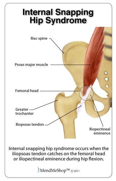 Snapping hip syndroom | Snapping hip syndrome, Massage therapy, Hips