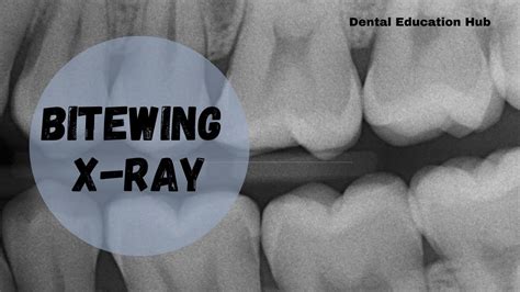 Bitewing X-ray | Intraoral Dental Radiograph - YouTube