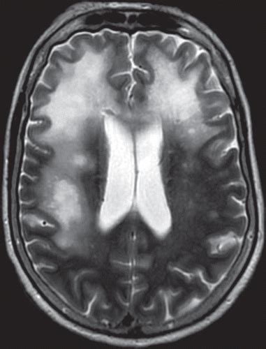 Chronic Small Vessel Ischemic Disease Icd 9 - Captions Hunter