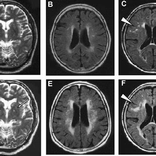 Chronic Small Vessel Ischemic Disease Icd 9 - Captions Hunter