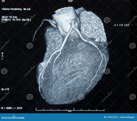 CT-Scan Heart Stock Photo - Image: 17951270