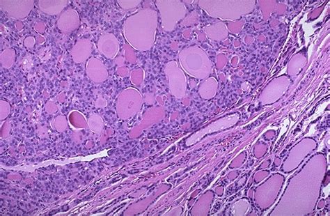 Thyroid Adenoma Histology