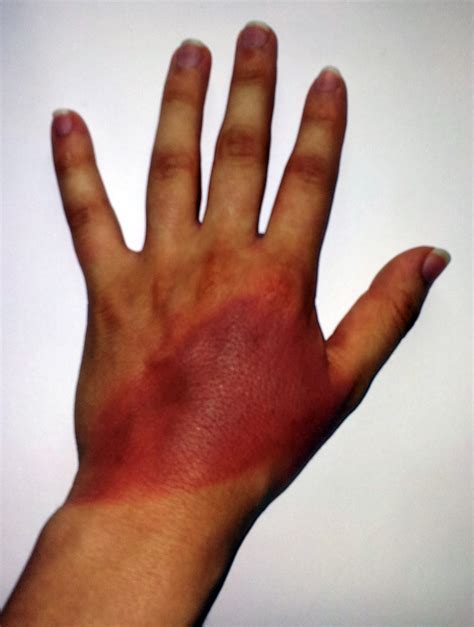 File:1Veertje hand burn.jpg