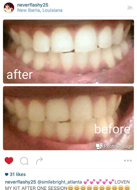 Before and After Pics | Smile Bright Teeth Whitening