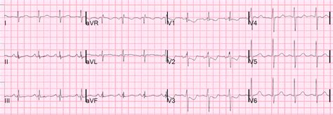 Dr. Smith's ECG Blog: ST Depression and T-wave inversion in V2 and V3.