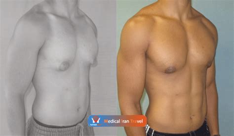 Gynecomastia Surgery in Iran | Risks,Result, 2021 Price | MITRAMED