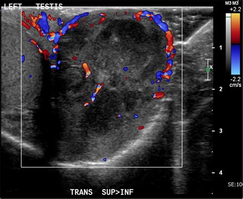 Tuberculous epididymo-orchitis masquerading as acute scrotum | BMJ Case ...