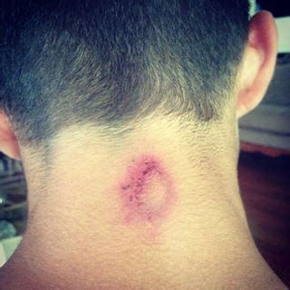 How to Treat & Prevent Paintball Bruises and Welts - PBguy