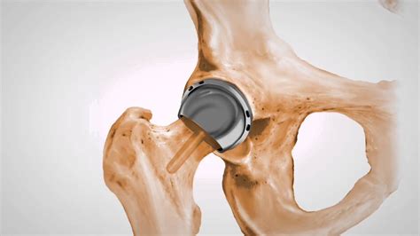 Stryker Recalls 2 Hip Implants | UnsafeProducts.com