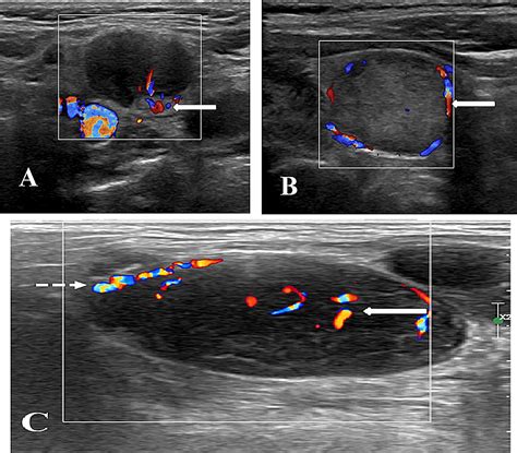 Cureus | Role of Sonoelastography in Differentiating Benign From Malignant Cervical Lymph Nodes ...