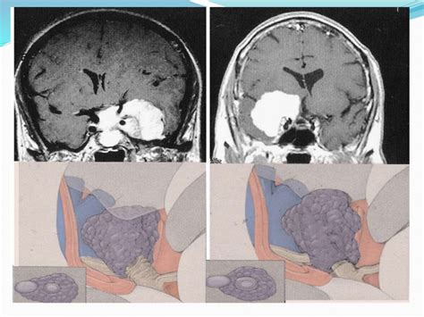 Sphenoid wing meningioma