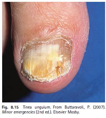 Onychomycosis