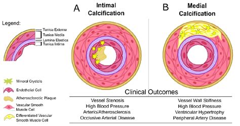 Intimal and Medial Calcification. (A) Intimal calcification is confined ...