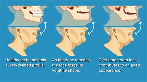 Wisdom Teeth Nerve Damage – Boston Dentist – Congress Dental Group 160 ...