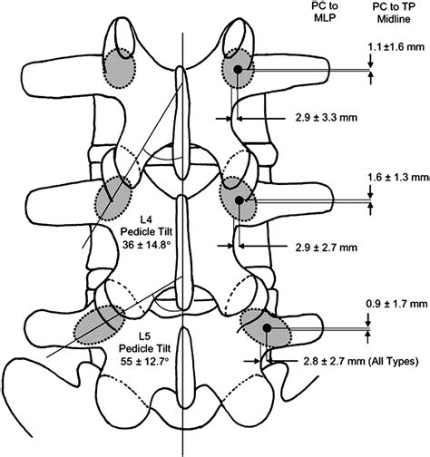 P157. An Anatomical Study which Describes the Relationship of the Pedicle Center to the Mid ...