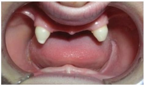 Ectodermal Dysplasia and Treatment of children With Ectodermal ...