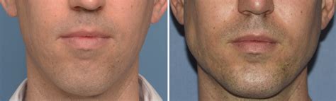 Chin and Jaw Angle Implants for Male Facial Enhancement - Explore ...