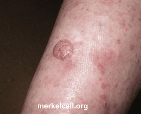 Clinical Photos of Merkel Cell Carcinoma | Merkel Cell Carcinoma