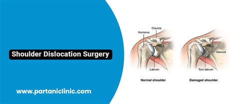 Shoulder Dislocation Surgery in Jaipur By Dr. Arun Partani | Partani Clinic