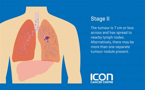 Stage 2 Of Lung Cancer