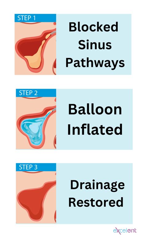 Balloon Sinuplasty Benefits - excelENT