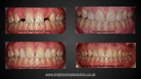 Missing Lateral Incisor Teeth, Brighton Implant Clinic : Dental Implants