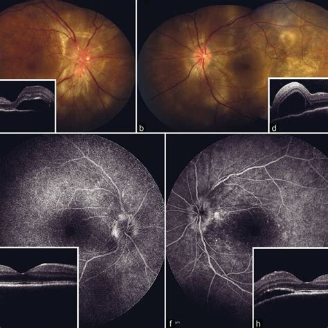 Case 2. At the first initiation. Color fundus pictures (a: Right eye ...