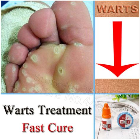 Aliexpress.com : Buy Chinese Medicine Treatment Foot Corn Removal Cream Plantar Warts Treatment ...