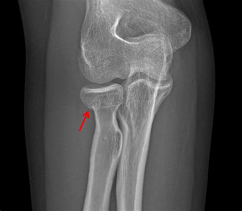 Condylar Neck Fracture