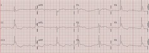 Dr. Smith's ECG Blog: Osborn Waves and Hypothermia