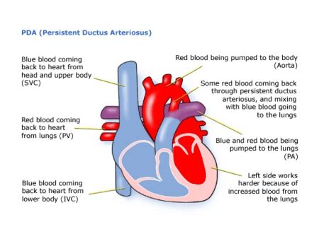 Children's Heart Federation | Persistent Ductus Arteriosus (PDA)