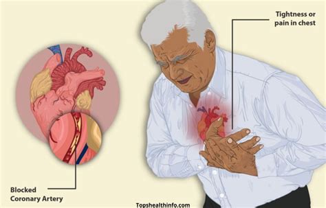 Angina Pectoris: Symptoms, Causes & Treatment (at Germany)