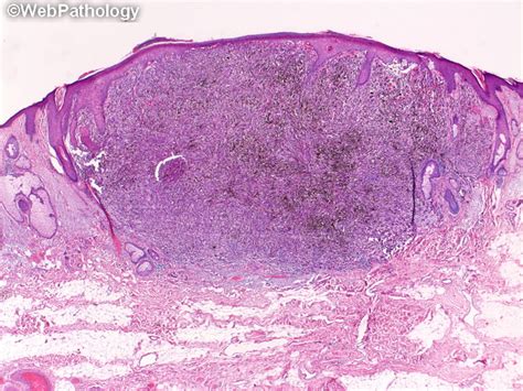 Nodular Melanoma Histology