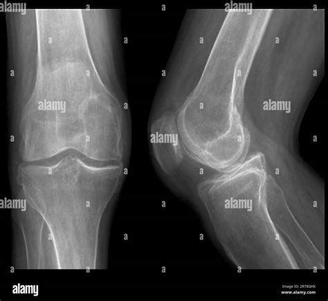 X-rays of the knee joint of a 59 year old male patient affected by chondrocalcinosis, or ...