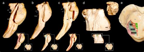 Lateral to medial dissection of the brainstem below the level of the ...