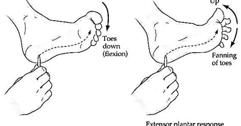 Plantar reflex ~ Online Preparation for NEET, AIIMS, USMLE, UPSC, PGI │www.EduMedWeb.com