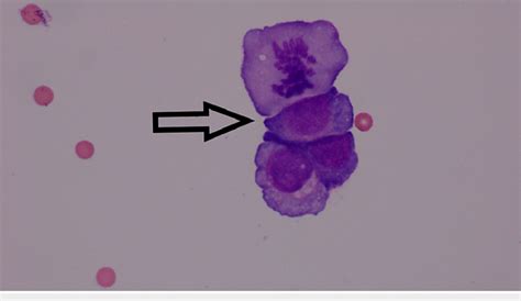 Eosin and methylene blue (E&M) stain showing atypical epithelial cells... | Download Scientific ...