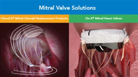 On-X Mitral Valve Solutions - Artivion