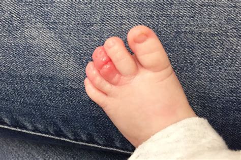 Hair tourniquet syndrome: 'Check your baby's toes' | Mum's Grapevine