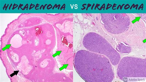 Hidradenoma (Acrospiroma) vs Spiradenoma/Cylindroma: 5-Minute Pathology ...