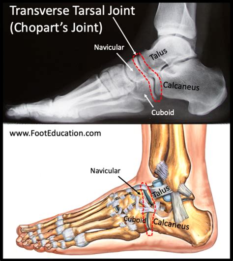 Transverse Tarsal Joint Injury-Sprain - FootEducation