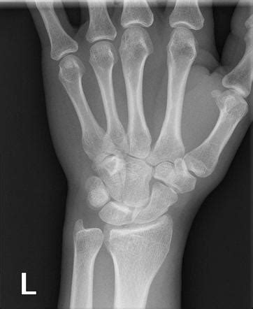 Occult fracture | Radiology Reference Article | Radiopaedia.org