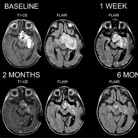 Brain MRI of the 3-year-old boy with pilocytic astrocytoma. Baseline MR ...