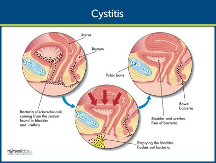 Cystitis Nursing Care and Management: Study Guide