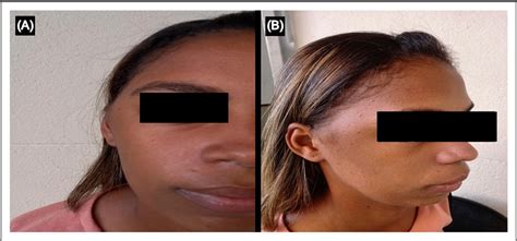 Angiolymphoid Hyperplasia With Temporal Artery Eosinophilia: A Case Report | Semantic Scholar