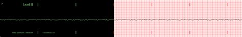 The Asystolic EKG/ECG