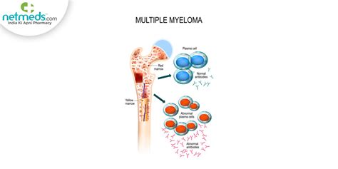 Multiple Myeloma: Causes, Symptoms And Treatment